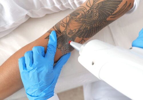 Laser-Tattooentfernung im Mittelpunkt: Ein neuer Anfang für das Herz